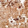 6N4 Metastasis, melanoma (Case 6N) S100.jpg