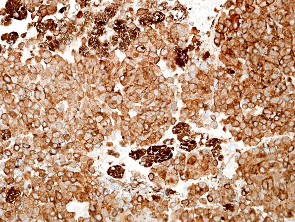 6N4 Metastasis, melanoma (Case 6N) S100.jpg