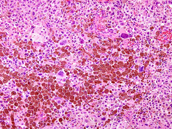 6O Metastasis, melanoma (Case 6O) H&E 1