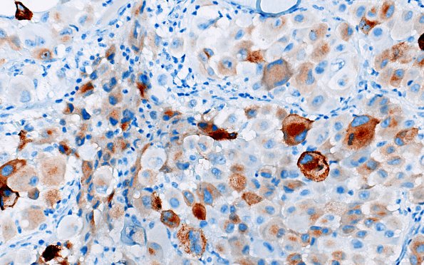 6P3 Metastasis, melanoma (Case 6P) Melan-A 1