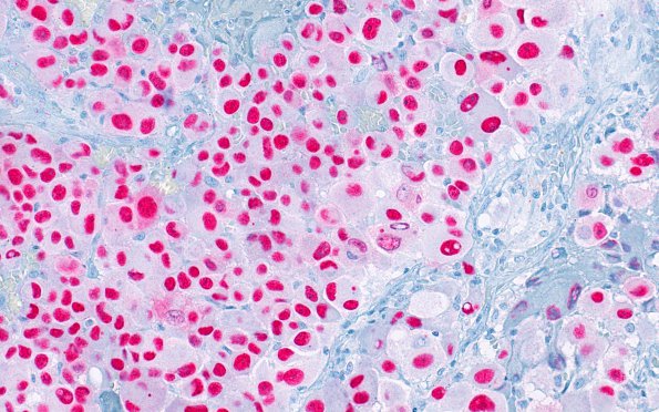 6P4 Metastasis, melanoma (Case 6P) SOX10 1