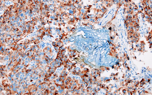 6Q1 Metastasis, melanoma (Case 6Q) HMB45 1