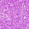 7A1 Metastasis, melanoma (Case 7A) H&E 7