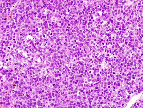 7A1 Metastasis, melanoma (Case 7A) H&E 7