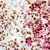 7A 2 Metastasis, melanoma (Case 7A) Mib-MelanA 9