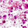 7B1 Metastasis, Melanoma (Case 7B) H&E smear 3