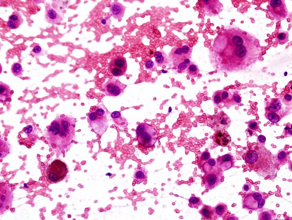 7B1 Metastasis, Melanoma (Case 7B) H&E smear 3