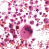 7B2 Metastasis, Melanoma (Case 7B) H&E smear 1