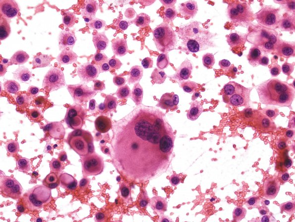 7B2 Metastasis, Melanoma (Case 7B) H&E smear 1