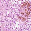 7B3 Metastasis, Melanoma (Case 7B) H&E 4