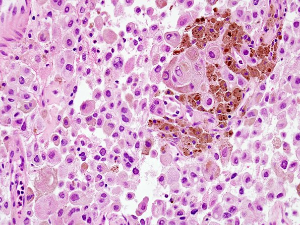 7B3 Metastasis, Melanoma (Case 7B) H&E 4