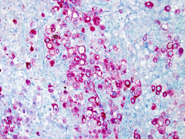 7B4 Metastasis, Melanoma (Case 7B) Melan-A 3