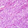 7C1 Metastasis, melanoma (Case 7C) H&E 1