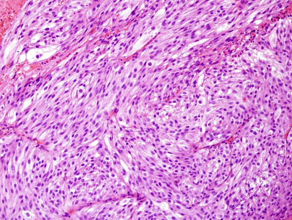 7C1 Metastasis, melanoma (Case 7C) H&E 1