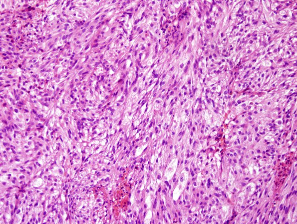 7C3 Metastasis, melanoma (Case 7C) H&E 4