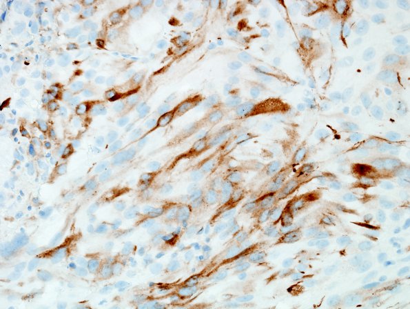 7C4 Metastasis, melanoma (Case 7C) Melan A 1