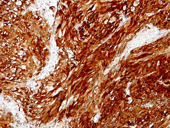 7C5 Metastasis, melanoma (Case 7C) S100 2