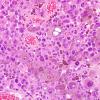 7D1 Metastasis, melanoma (Case 7D) H&E 4.jpg