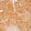 7D3 Metastasis, melanoma (Case 7D) S100 2.jpg