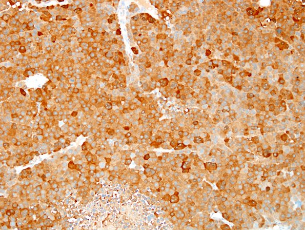 7D3 Metastasis, melanoma (Case 7D) S100 2.jpg