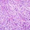 7E Metastasis, melanoma (Case 7E) H&E 3.jpg