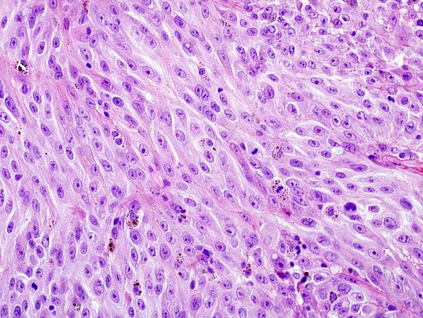 7E Metastasis, melanoma (Case 7E) H&E 3.jpg