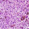 7F1 Metastasis, melanoma (Case 7F) H&E 1.jpg