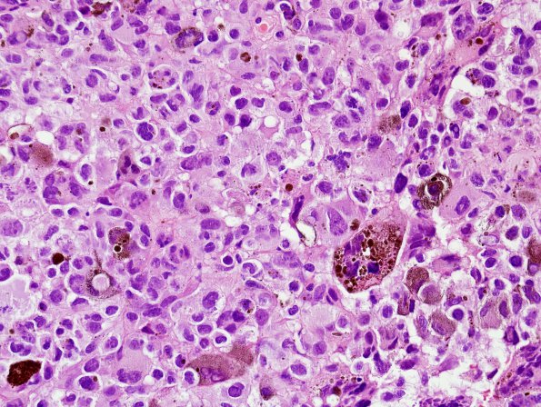 7F1 Metastasis, melanoma (Case 7F) H&E 1.jpg