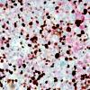 7F2 Metastasis, melanoma (Case 7F) MelanA- Ki67 5.jpg