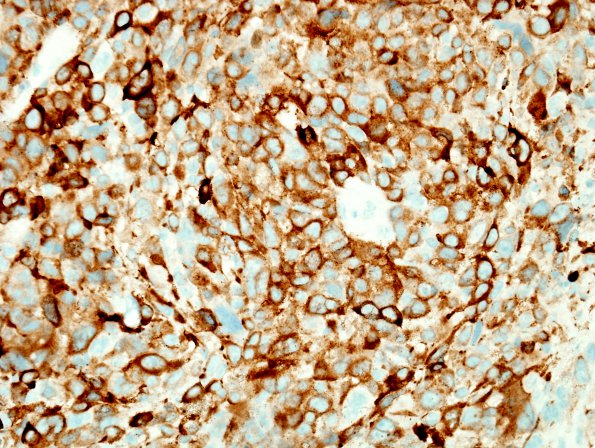 7F3 Metastasis, melanoma (Case 7F) MelanA.jpg