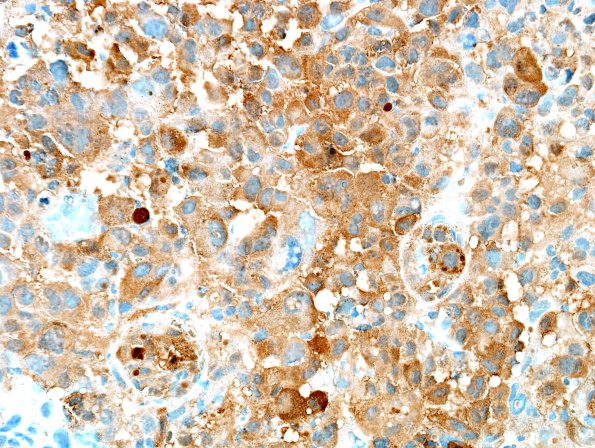 7F4 Metastasis, melanoma (Case 7F) S100.jpg