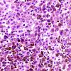 7G1 Metastatic melanoma (Case 7H) H&E 40X