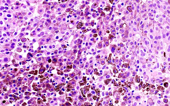 7G1 Metastatic melanoma (Case 7H) H&E 40X