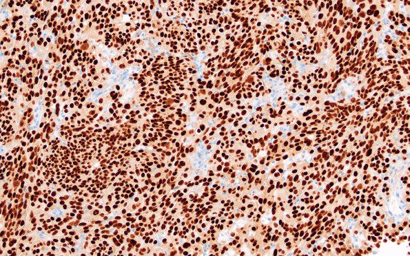 7G4 Metastatic melanoma (Case 7H) SOX10 20X