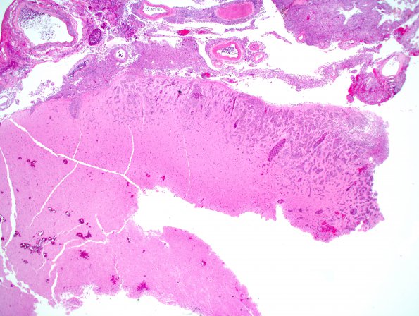 8A1 Metastasis, melanoma (Case 8) 2X H&E.jpg