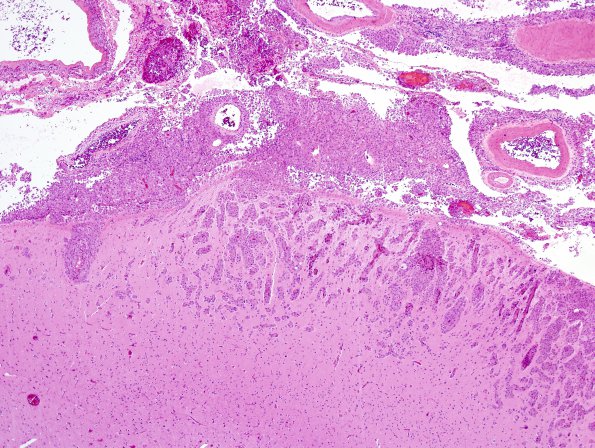 8A2 Metastasis, melanoma (Case 8) H&E 7