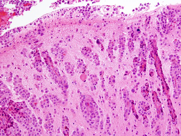 8A3 Metastasis, melanoma (Case 8) H&E 2