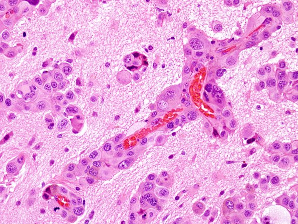 8A4 Metastasis, melanoma (Case 8) H&E 3