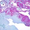 8C1 Metastasis, melanoma (Case 8) 2X Melan-A.jpg