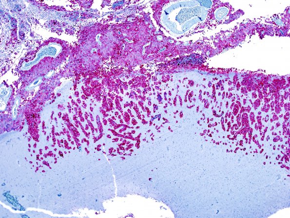 8C2 Metastasis, melanoma (Case 8) Melan-A 4