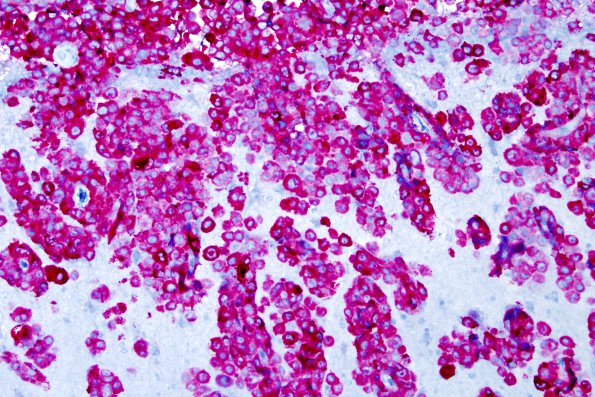 8C3 Metastasis, melanoma (Case 8) Melan-A 1