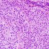 9A1 Metastasis, melanoma (Case 9) H&E 1.jpg