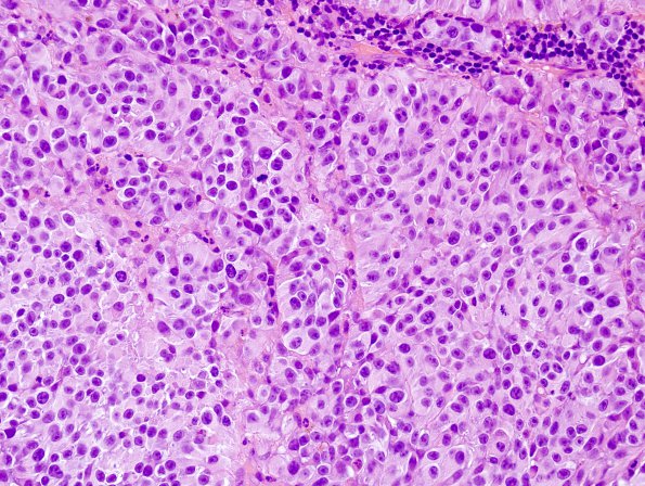 9A1 Metastasis, melanoma (Case 9) H&E 1.jpg