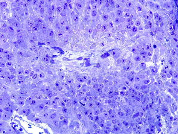 9C Melanoma, metastatic (Case 9) Plastic 3.jpg