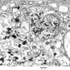 9D1 Metastasis, amelanotic melanoma (Case 9) EM 009 - Copy