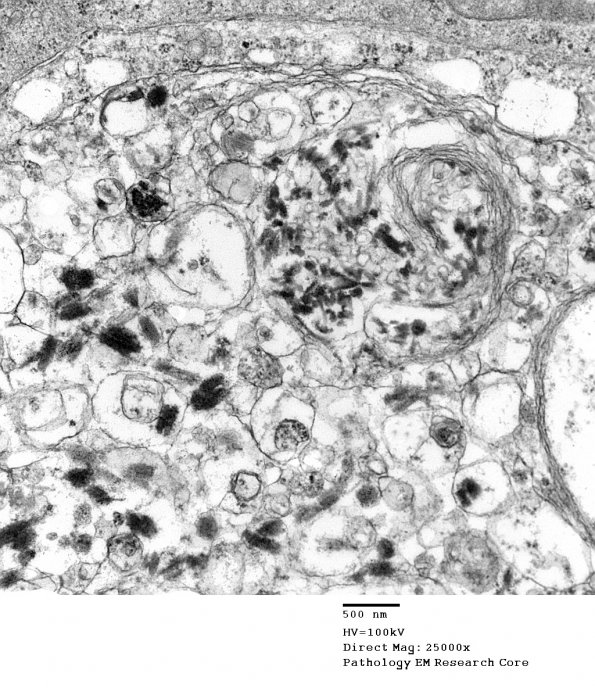 9D1 Metastasis, amelanotic melanoma (Case 9) EM 009 - Copy