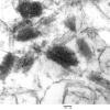 9D2 Metastasis, amelanotic melanoma (Case 9) EM 010 - Copy