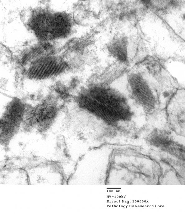 9D2 Metastasis, amelanotic melanoma (Case 9) EM 010 - Copy