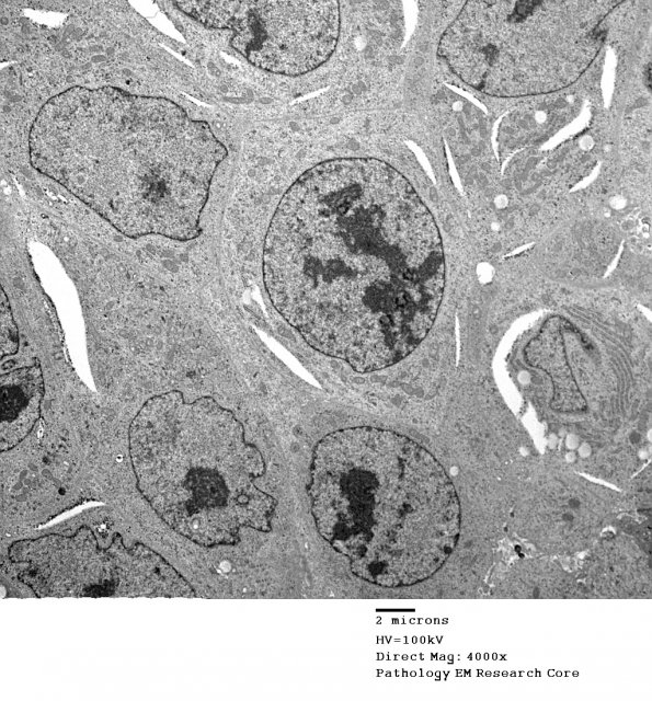 9D3 Metastasis, amelanotic melanoma (Case 9) EM 026 - Copy