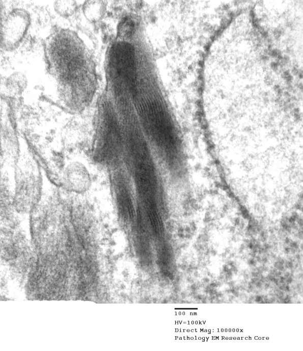 9D4 Metastasis, amelanotic melanoma (Case 9) EM 020 - Copy